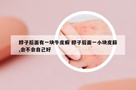 脖子后面有一塊牛皮癬 脖子后面一小塊皮蘚,會不會自己好