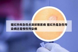 猩紅熱和急性點(diǎn)滴狀銀屑病 猩紅熱是急性傳染病還是慢性傳染病