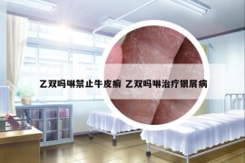 乙雙嗎啉禁止牛皮癬 乙雙嗎啉治療銀屑病