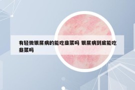 有輕微銀屑病的能吃韭菜嗎 銀屑病到底能吃韭菜嗎