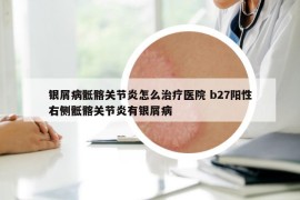 銀屑病骶髂關(guān)節(jié)炎怎么治療醫(yī)院 b27陽性右側(cè)骶髂關(guān)節(jié)炎有銀屑病