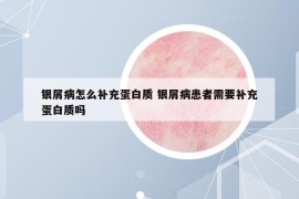 銀屑病怎么補充蛋白質(zhì) 銀屑病患者需要補充蛋白質(zhì)嗎
