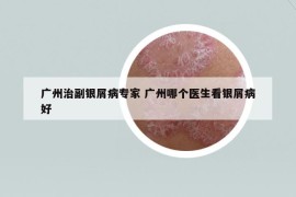 廣州治副銀屑病專家 廣州哪個(gè)醫(yī)生看銀屑病好