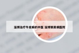 淄博治療牛皮癬的中醫(yī) 淄博銀屑病醫(yī)院