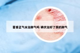藿香正氣水治腳氣嗎 碘伏治好了我的腳氣