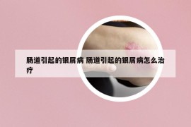 腸道引起的銀屑病 腸道引起的銀屑病怎么治療