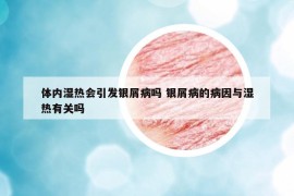 體內(nèi)濕熱會引發(fā)銀屑病嗎 銀屑病的病因與濕熱有關嗎