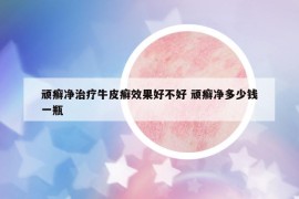 頑癬凈治療牛皮癬效果好不好 頑癬凈多少錢一瓶