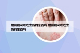 銀屑病可以吃太熱的東西嗎 銀屑病可以吃太熱的東西嗎