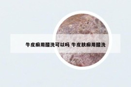 牛皮癬用醋洗可以嗎 牛皮膚癬用醋洗