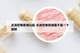 點滴型銀屑病凸起 點滴型銀屑病是不是一個很硬