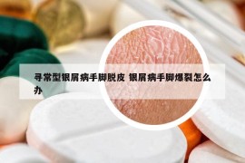 尋常型銀屑病手腳脫皮 銀屑病手腳爆裂怎么辦