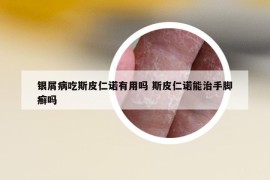 銀屑病吃斯皮仁諾有用嗎 斯皮仁諾能治手腳癬嗎