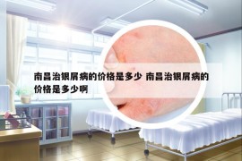 南昌治銀屑病的價格是多少 南昌治銀屑病的價格是多少啊