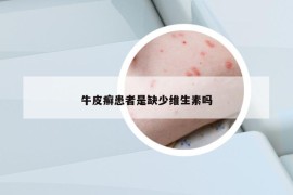 牛皮癬患者是缺少維生素嗎