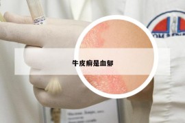 牛皮癬是血郁