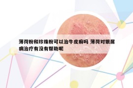 薄荷粉和珍珠粉可以治牛皮癬嗎 薄荷對(duì)銀屑病治療有沒(méi)有幫助呢