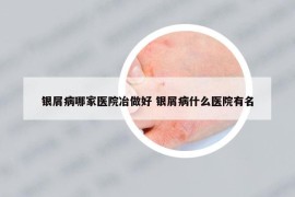 銀屑病哪家醫(yī)院冶做好 銀屑病什么醫(yī)院有名