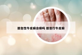 膿包性牛皮癬會癢嗎 膿包行牛皮癬