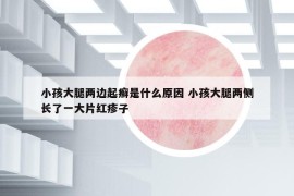 小孩大腿兩邊起癬是什么原因 小孩大腿兩側(cè)長(zhǎng)了一大片紅疹子