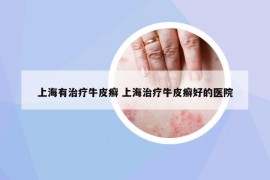 上海有治療牛皮癬 上海治療牛皮癬好的醫(yī)院