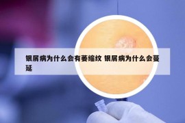 銀屑病為什么會(huì)有萎縮紋 銀屑病為什么會(huì)蔓延