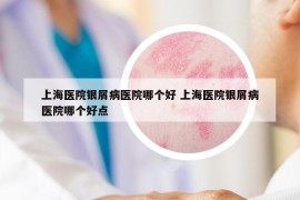 上海醫(yī)院銀屑病醫(yī)院哪個好 上海醫(yī)院銀屑病醫(yī)院哪個好點(diǎn)
