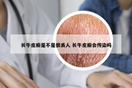 長牛皮癬是不是很丟人 長牛皮癬會傳染嗎