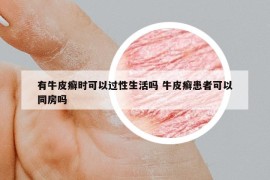 有牛皮癬時(shí)可以過(guò)性生活嗎 牛皮癬患者可以同房嗎