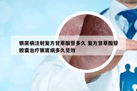 銀屑病注射復(fù)方甘草酸苷多久 復(fù)方甘草酸苷膠囊治療銀屑病多久見效