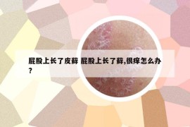 屁股上長(zhǎng)了皮蘚 屁股上長(zhǎng)了蘚,很癢怎么辦?