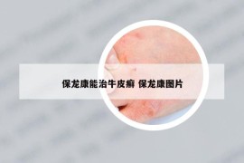 保龍康能治牛皮癬 保龍康圖片