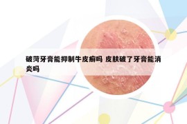 破菏牙膏能抑制牛皮癬嗎 皮膚破了牙膏能消炎嗎