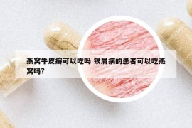 燕窩牛皮癬可以吃嗎 銀屑病的患者可以吃燕窩嗎?