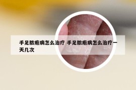 手足膿皰病怎么治療 手足膿皰病怎么治療一天幾次