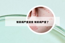 銀屑病嚴(yán)重速度 銀屑病嚴(yán)重了