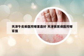 天津牛皮癬醫(yī)院哪里最好 天津銀屑病醫(yī)院哪家強(qiáng)