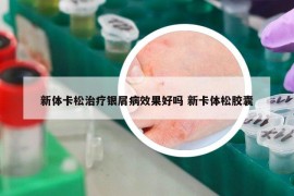 新體卡松治療銀屑病效果好嗎 新卡體松膠囊