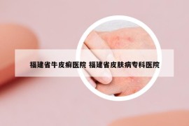 福建省牛皮癬醫(yī)院 福建省皮膚病?？漆t(yī)院
