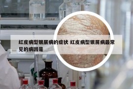 紅皮病型銀屑病的癥狀 紅皮病型銀屑病最常見的病因是