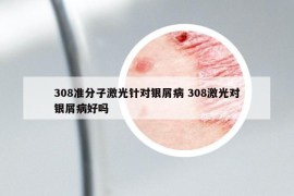 308準分子激光針對銀屑病 308激光對銀屑病好嗎