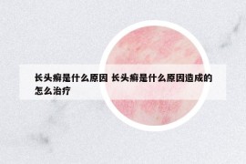長(zhǎng)頭癬是什么原因 長(zhǎng)頭癬是什么原因造成的怎么治療