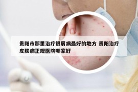 貴陽市那里治療銀屑病最好的地方 貴陽治療皮膚病正規(guī)醫(yī)院哪家好