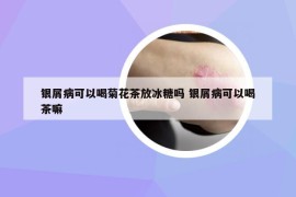 銀屑病可以喝菊花茶放冰糖嗎 銀屑病可以喝茶嘛