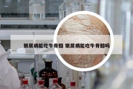 銀屑病能吃牛骨髓 銀屑病能吃牛骨髓嗎