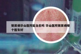 銀屑病華山醫(yī)院能治愈嗎 華山醫(yī)院銀屑病哪個(gè)醫(yī)生好