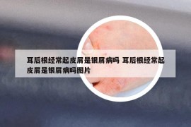 耳后根經(jīng)常起皮屑是銀屑病嗎 耳后根經(jīng)常起皮屑是銀屑病嗎圖片