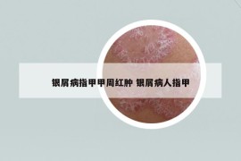 銀屑病指甲甲周紅腫 銀屑病人指甲