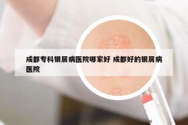 成都?？沏y屑病醫(yī)院哪家好 成都好的銀屑病醫(yī)院