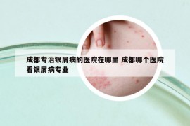 成都專治銀屑病的醫(yī)院在哪里 成都哪個醫(yī)院看銀屑病專業(yè)